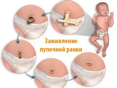 Мокне пупок у новонародженого причини і правила обробки (мокне пупок новонародженого) Мокне пупок у новонародженого причини і правила обробки