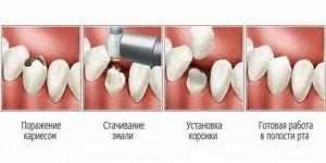 Чи можна наростити зуб, якщо залишився тільки корінь, і відновити коронку (тільки) Чи можна наростити зуб, якщо залишився тільки корінь, і відновити коронку