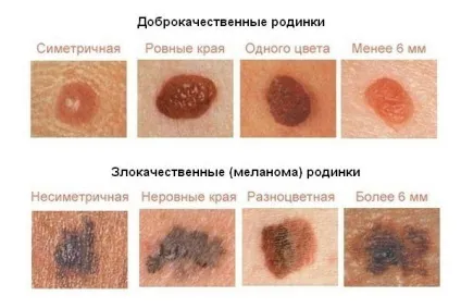 Чи можна без операції зменшити родимку (як зменшити родимку) Чи можна без операції зменшити родимку
