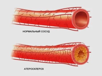 Мультифокальний атеросклероз - що це таке, нижніх кінцівок, коронарних артерій, лікування, (мультифокальний) Мультифокальний атеросклероз - що це таке, нижніх кінцівок, коронарних артерій, лікування,