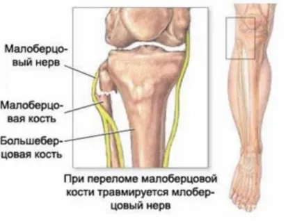 Невропатія малогомілкового нерва