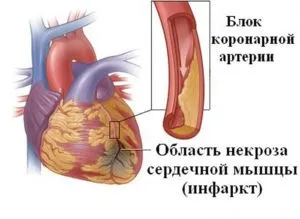 Профілактика атеросклерозу - продукти та народними засоби (атеросклерозу) Профілактика атеросклерозу - продукти та народними засоби