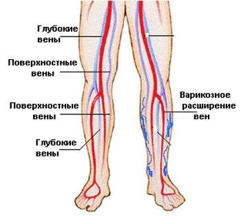 Причини виникнення варикозу що сприяє розвитку цієї хвороби (хвороби) Причини виникнення варикозу що сприяє розвитку цієї хвороби