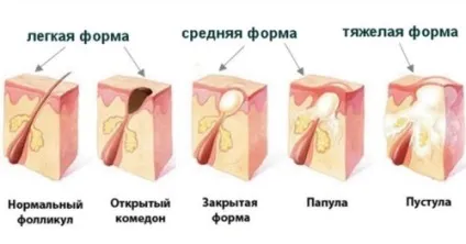 Прищі на голові чому з'являються і як лікувати (голові) Прищі на голові чому з'являються і як лікувати