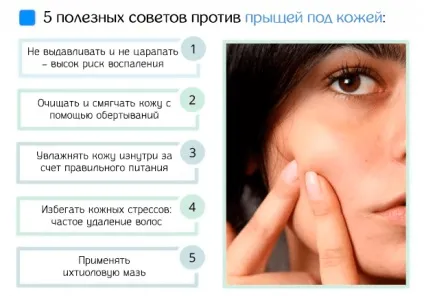 Прищі під шкірою - причини і способи їх видалення (прищі) Прищі під шкірою - причини і способи їх видалення