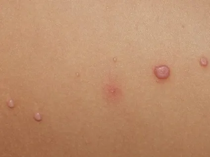 Прищі на голові чому з'являються і як лікувати (з'являються) Прищі на голові чому з'являються і як лікувати