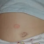 Оперізуючий лишай заразний чи ні, як передається захворювання, профілактика (передається) Оперізуючий лишай заразний чи ні, як передається захворювання, профілактика