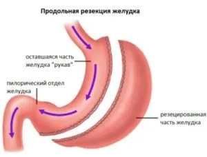 Операція при виразці шлунка показання до хірургічного втручання (операція) Операція при виразці шлунка показання до хірургічного втручання