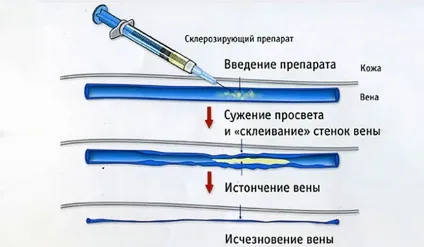 Операція на варикоз класифікація, показання, побічні ефекти (операція) Операція на варикоз класифікація, показання, побічні ефекти