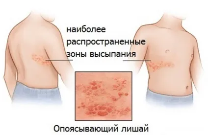 Оперізуючий лишай заразний чи ні для оточуючих (лишай) Оперізуючий лишай заразний чи ні для оточуючих
