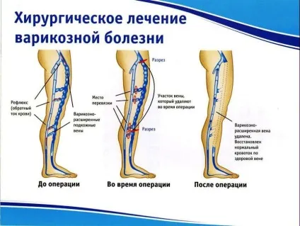 Операція на варикоз класифікація, показання, побічні ефекти (показання) Операція на варикоз класифікація, показання, побічні ефекти