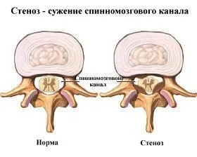 Остеохондроз «жаліти» або «закачувати» спину, cmt науковий підхід (остеохондроз) Остеохондроз «жаліти» або «закачувати» спину, cmt науковий підхід