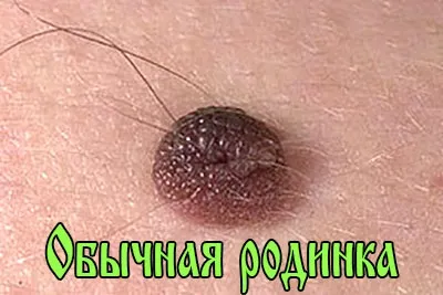 Освітлення шкіри трехпроцентной перекисом водню - як видалити пігментні плями, лікування в (перекисом) Освітлення шкіри трехпроцентной перекисом водню - як видалити пігментні плями, лікування в