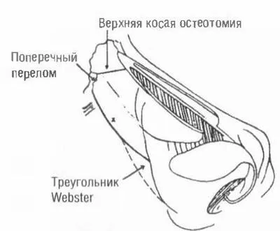 Остеотомія кісток пірамідки носа (носа) Остеотомія кісток пірамідки носа