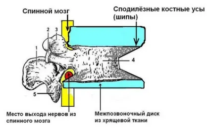 Остеофіти хребта лікування і профілактика (хребта) Остеофіти хребта лікування і профілактика