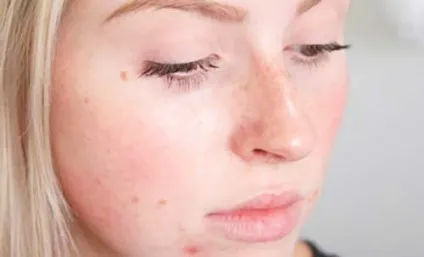 Від засмаги з'явилися прищі, що робити якщо прищі сверблять після засмаги - відповідь на сайті (робити) Від засмаги з'явилися прищі, що робити якщо прищі сверблять після засмаги - відповідь на сайті