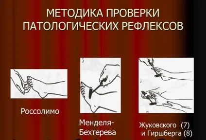 Патологічні рефлекси (Бабинського, Россолімо, Оппенгейма та інші) як перевіряються і на що (патологічні) Патологічні рефлекси (Бабинського, Россолімо, Оппенгейма та інші) як перевіряються і на що