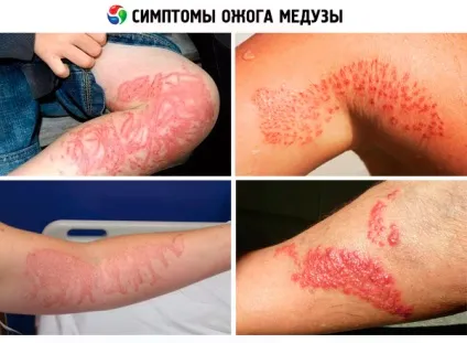 Опік медузи причини, симптоми, діагностика, лікування, компетентно про здоров'я на ilive (лікування) Опік медузи причини, симптоми, діагностика, лікування, компетентно про здоров'я на ilive