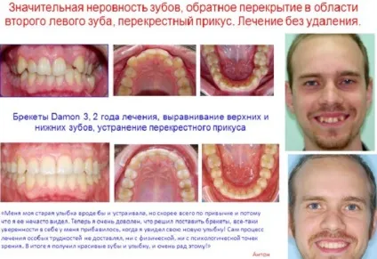 Перехресний прикус у дорослих і дітей лікування, виправлення, фото патології (перехресний прикус) Перехресний прикус у дорослих і дітей лікування, виправлення, фото патології