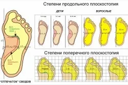 Плоскостопість причини, симптоми і лікування (симптоми) Плоскостопість причини, симптоми і лікування