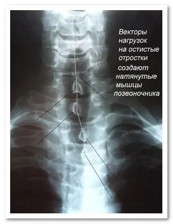 Чому болить шийний відділ хребта (хребта) Чому болить шийний відділ хребта