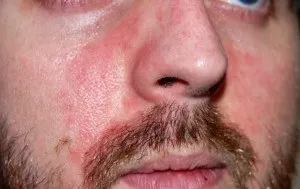 Чому після вживання алкоголю з'являються червоні плями на обличчі (чому) Чому після вживання алкоголю з'являються червоні плями на обличчі