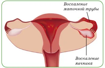 Чому розвивається хронічний уреаплазмоз, це самолікування таблетками (Лікування хронічного уреаплазмоза жінок) Чому розвивається хронічний уреаплазмоз, це самолікування таблетками