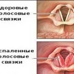 Пропав голос і кашель як лікувати горло якщо болить