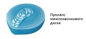 Пролапс диска хребта, діагностика і симптоми, лікування