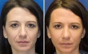 Процедура та відгуки липофилинг особи, носо-губних складок і інших ділянок, фото до і після (особи) Процедура та відгуки липофилинг особи, носо-губних складок і інших ділянок, фото до і після