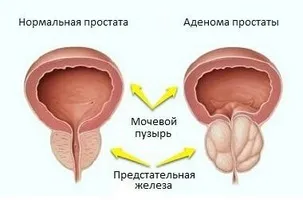Прополіс як ефективний засіб для лікування аденоми простати (засіб) Прополіс як ефективний засіб для лікування аденоми простати