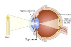 Підвивих і вивих кришталика симптоми і лікування (вивих) Підвивих і вивих кришталика симптоми і лікування