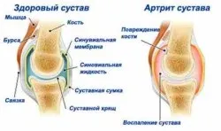 Поліартрит причини, симптоми і лікування
