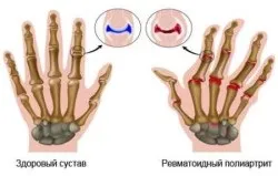 Поліартрит причини, симптоми і лікування