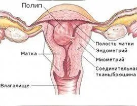Поліп ендометрія - симптоми і лікування (ендометрія) Поліп ендометрія - симптоми і лікування