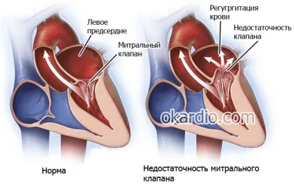 Порок серця що це таке, причини, симптоми, лікування і прогноз