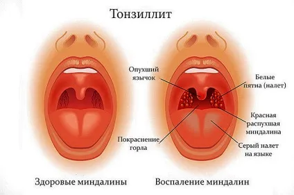 Полоскання горла сіллю - як можна це робити солоною водою (солоної) Полоскання горла сіллю - як можна це робити солоною водою