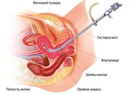 Поліпоз ендометрія ефективне лікування і профілактика захворювання (захворювання) Поліпоз ендометрія ефективне лікування і профілактика захворювання