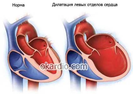 Порок серця що це таке, причини, симптоми, лікування і прогноз