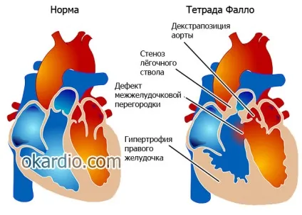 Порок серця що це таке, причини, симптоми, лікування і прогноз
