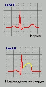 пошкодження міокарда