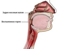 Постназального синдром (затік) причини, лікування затікання слизу (причини) Постназального синдром (затік) причини, лікування затікання слизу