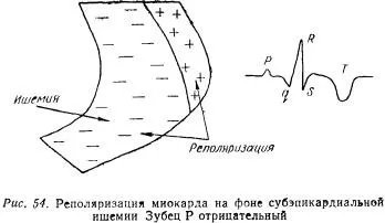 Посібник по ЕКГ (підручник) - розшифровка ЕКГ