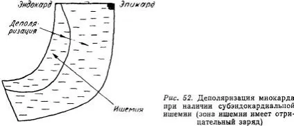 Посібник по ЕКГ (підручник) - розшифровка ЕКГ