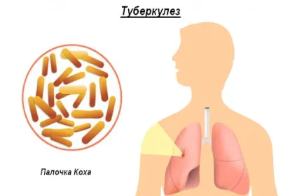 Посттравматическая пневмонія і захворювання, що викликають пневмонію (захворювання) Посттравматическая пневмонія і захворювання, що викликають пневмонію