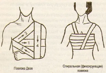 Пов'язка на плечовий суглоб, колосовидная, при вивиху, яка фіксує, Дезо, косиночная, як накласти (вивиху) Пов'язка на плечовий суглоб, колосовидная, при вивиху, яка фіксує, Дезо, косиночная, як накласти