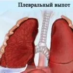 Переважна локалізація хоріона задня (локалізація) Переважна локалізація хоріона задня