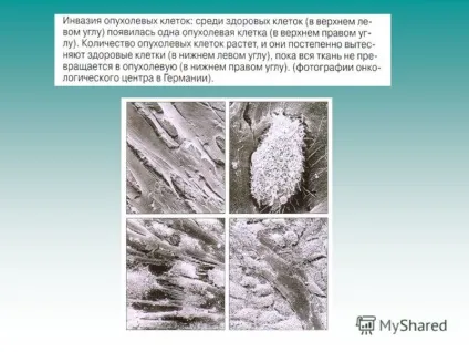 Презентація на тему онкологія матеріал підготувала вчитель біології МОУ - сош 198 - яппарова (онкологія матеріал підготувала вчитель біології МОУ «сош 198» яппарова татьяна Смелаовна.) Презентація на тему онкологія матеріал підготувала вчитель біології МОУ - сош 198 - яппарова