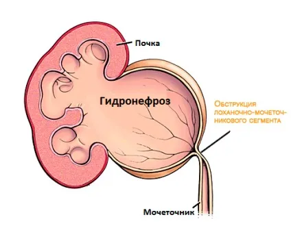 Причини і лікування гідронефрозу у плода, новонароджених і дітей (лікування) Причини і лікування гідронефрозу у плода, новонароджених і дітей