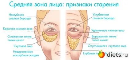 Ознаки старіння середньої зони особи звідки беруться - мішки - під очима і носогубні складки (зони) Ознаки старіння середньої зони особи звідки беруться - мішки - під очима і носогубні складки